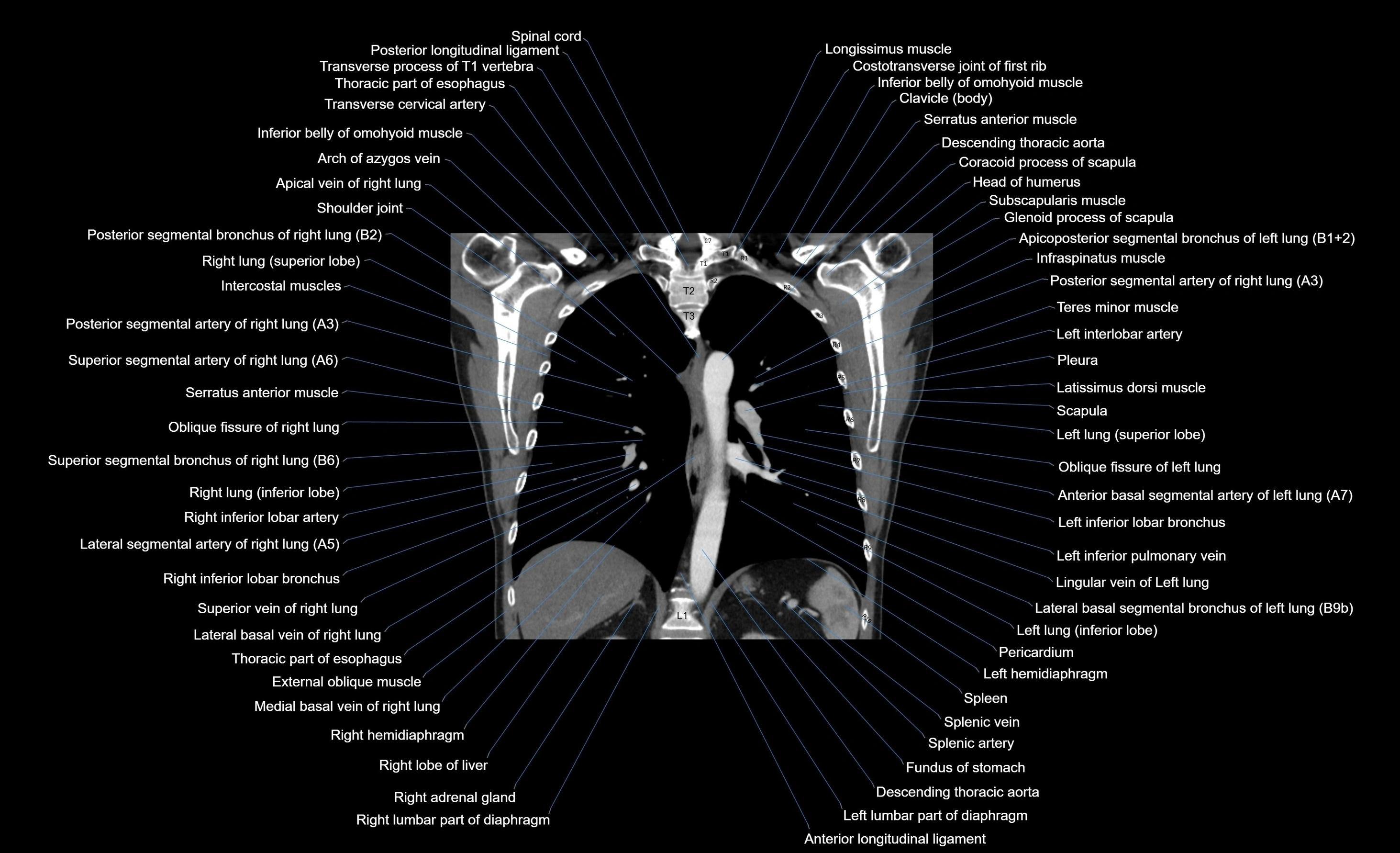 CT chest (thorax) soft tissue window labelled coronal cross sectional anatomy radiology image-00049.webp